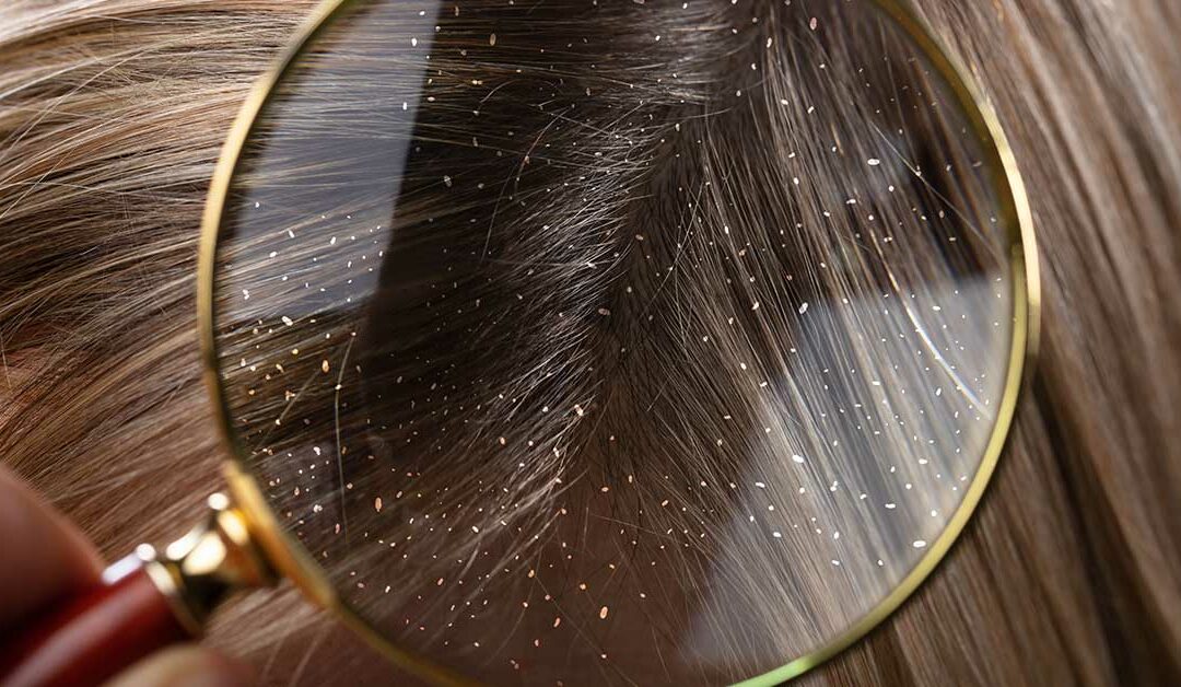 10 Natural Remedies for Dandruff